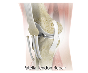 Patellar Tendon Repair - Educational Picture